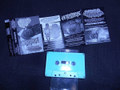 3 way split tape with metastasis and Trabecular Hepatocellular Carcinoma