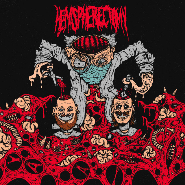 Hemispherectomy
