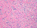 Dermatofibroma