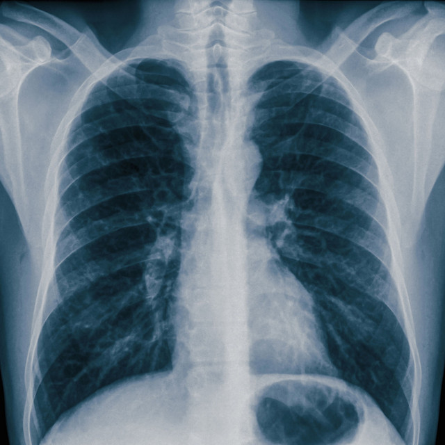 Lung