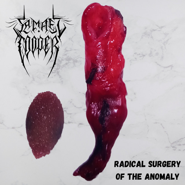 Radical Surgery of the Anomaly