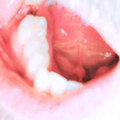 Dry Socket