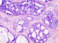 Ductal Carcinoma In Situ
