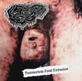 Postmortem fetal extrusion EP