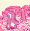 Dysplasia