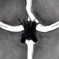 haemolacria (Auðmannastjórnvaldaembættisstjórnmálaverkalýðsverðlausraverðbréfaábyrgðarlausrakvóta-ræningjaaftaníossaspilling)